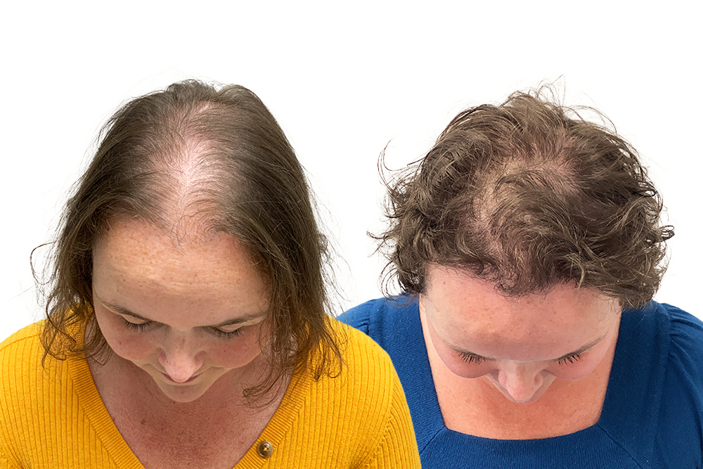 Kvinnlig hårtransplantation resultat