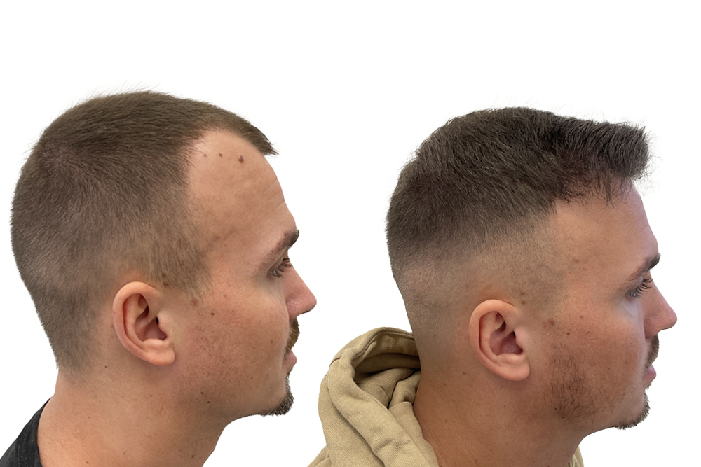 Nordic hair clinic resultat