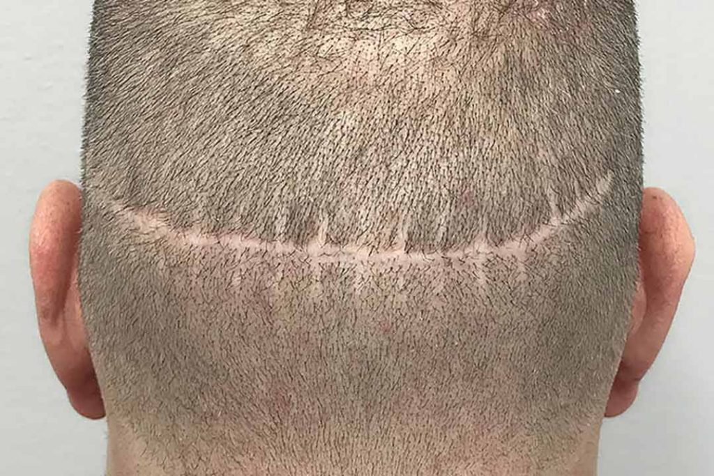hårtransplantation tekniker
