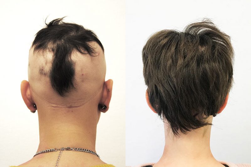Alopecia totalis