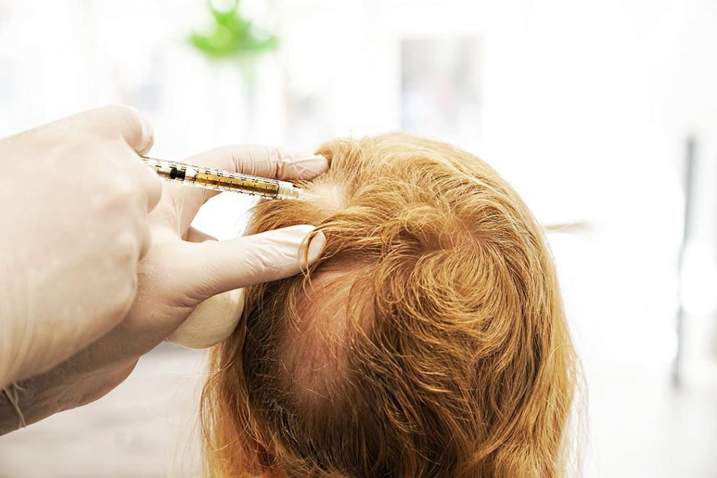 kvinna med alopecia areata gör harbehandling-behandling