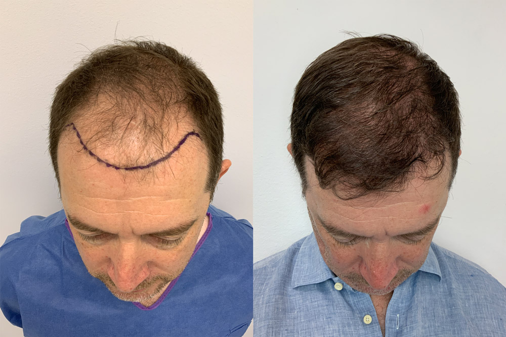 resultat hårtransplantation man