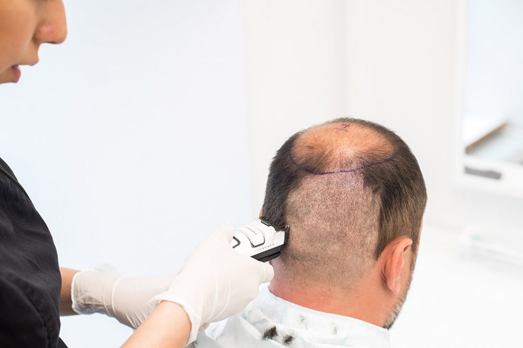 man rakar håret inför en hårtransplantation